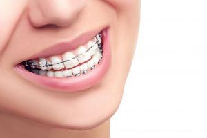 close-up of braces