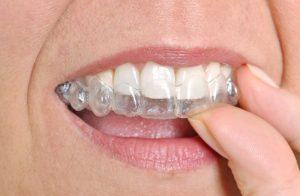 teeth with Invisalign 