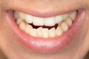 slightly crooked teeth