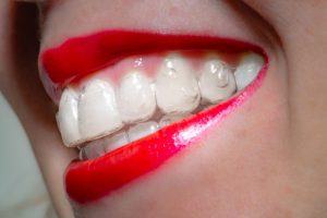 woman with Invisalign and attachments