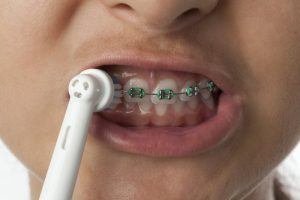 girl with braces using an electric toothbrush