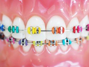 closeup of teeth with colorful braces
