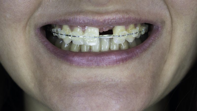 Shirck Can You Get Orthodontics If You Have Missing Teeth? | Shirck ...
