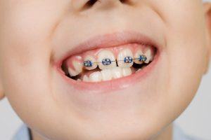 closeup of braces with baby teeth