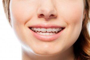 young woman with clear braces