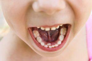 closeup of a child with overlapping teeth