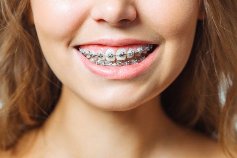 How to Deal with Swollen Gums Due to Braces Shirck Orthodontics