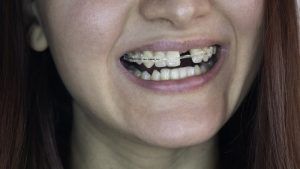 closeup of woman with braces and missing front tooth 