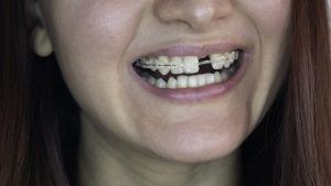 closeup of woman with braces and missing front tooth