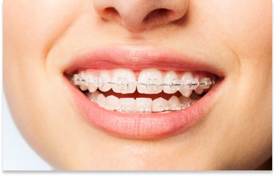 Clear or Ceramic Braces