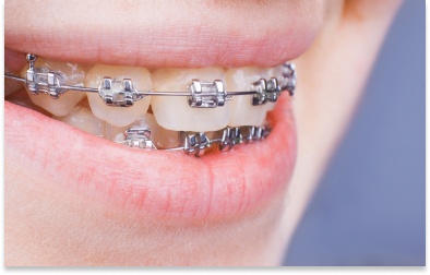 Traditional Braces