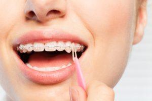 Braces in Westerville, OH